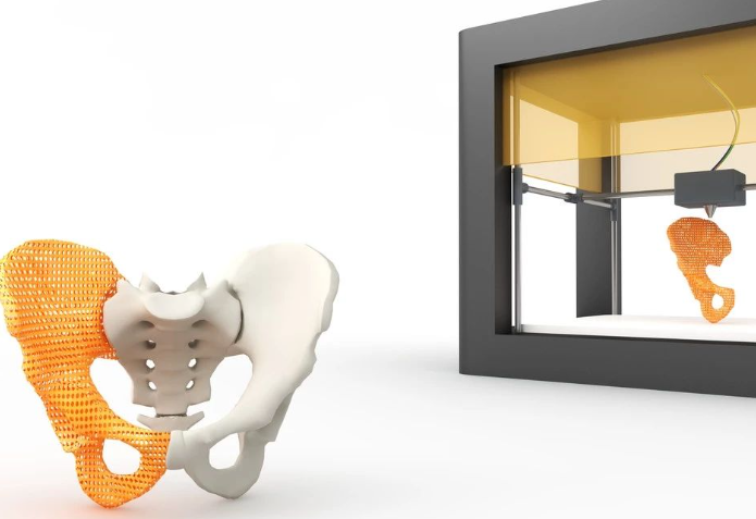 3D打印骨科内固定技术如何帮助患者更快恢复行动力?